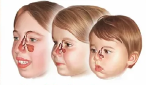 anatomia dos seios da face e sinusite 