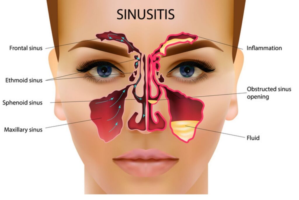 sinusite e seios da face